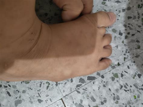 Bukol sa pwet Hi mga mommies, ano po kaya pwede pang gamot s.